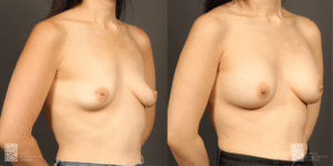 Before-and-after side-by-side photos of a woman's torso showing breast augmentation results: left with smaller, sagging breasts; right with fuller, lifted breasts.